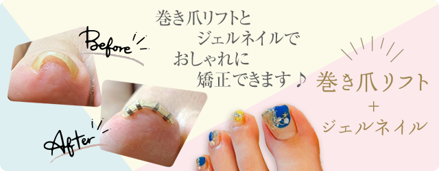 巻き爪リフト